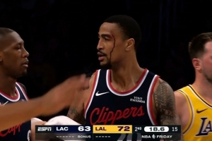 科林斯：左眉上方缝了几针 暂时感觉良好 明天进一步检查才能确定